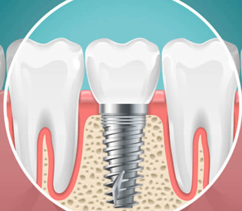 Dental Implant